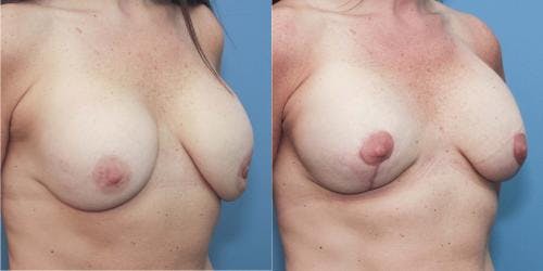 Breast Augmentation Before & After Gallery - Patient 58213172 - Image 3