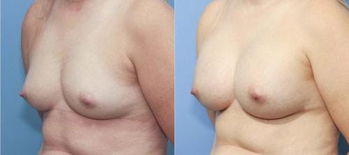 Breast Augmentation Before & After Gallery - Patient 58213173 - Image 2