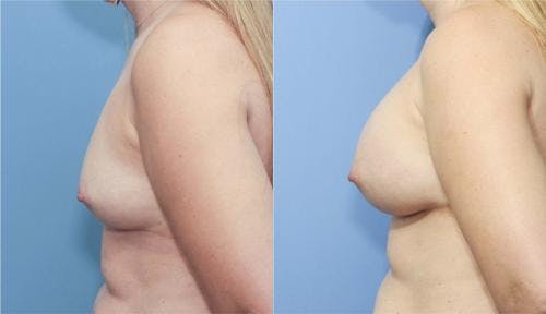 Breast Augmentation Before & After Gallery - Patient 58213173 - Image 3