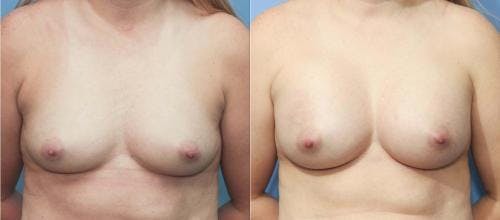 Breast Augmentation Before & After Gallery - Patient 58213173 - Image 1