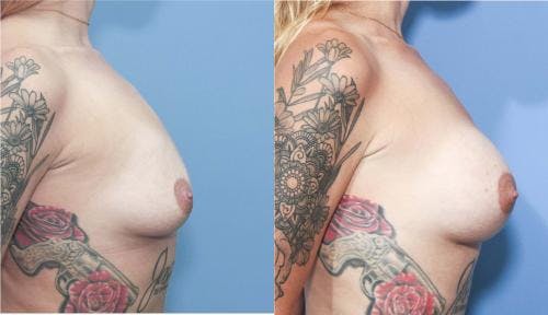 Breast Augmentation Before & After Gallery - Patient 58213174 - Image 2