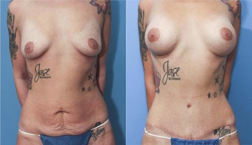 Breast Augmentation Before & After Gallery - Patient 58213174 - Image 3