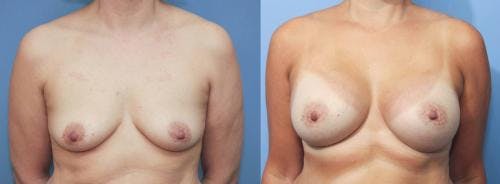 Breast Augmentation Before & After Gallery - Patient 58213177 - Image 1