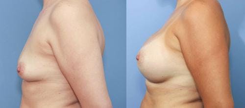 Breast Augmentation Before & After Gallery - Patient 58213177 - Image 2