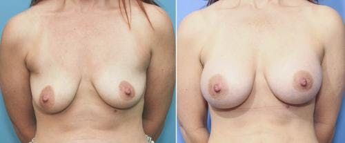 Breast Augmentation Before & After Gallery - Patient 58213178 - Image 1