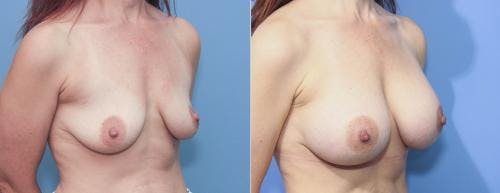 Breast Augmentation Before & After Gallery - Patient 58213178 - Image 2