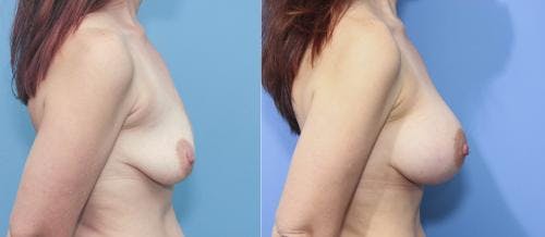 Breast Augmentation Before & After Gallery - Patient 58213178 - Image 3