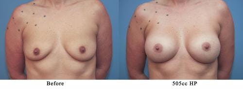 Breast Augmentation Before & After Gallery - Patient 58213179 - Image 1