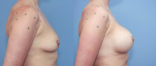 Breast Augmentation Before & After Gallery - Patient 58213179 - Image 2