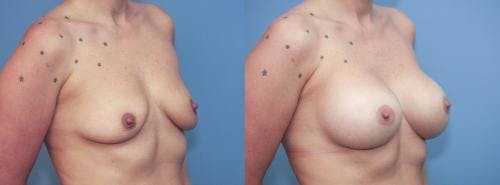 Breast Augmentation Before & After Gallery - Patient 58213179 - Image 3