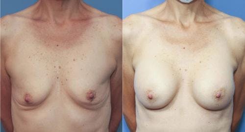 Breast Augmentation Before & After Gallery - Patient 58213182 - Image 1