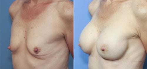 Breast Augmentation Before & After Gallery - Patient 58213182 - Image 2