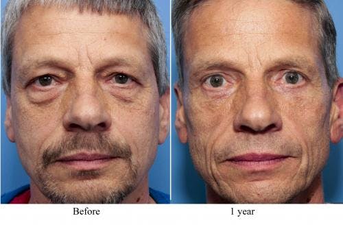 Brow Lift Before & After Gallery - Patient 58213181 - Image 1