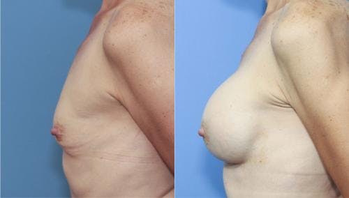 Breast Augmentation Before & After Gallery - Patient 58213182 - Image 3