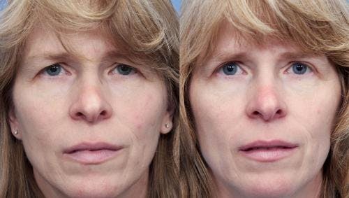 Brow Lift Before & After Gallery - Patient 58213183 - Image 1