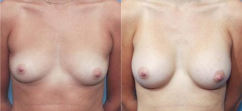 Breast Augmentation Before & After Gallery - Patient 58213185 - Image 1