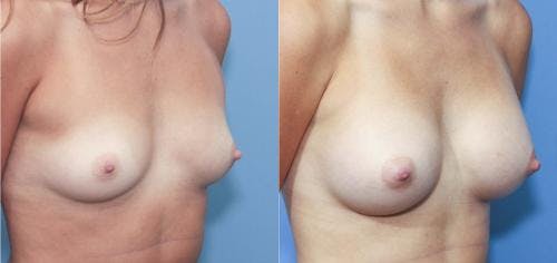 Breast Augmentation Before & After Gallery - Patient 58213185 - Image 2