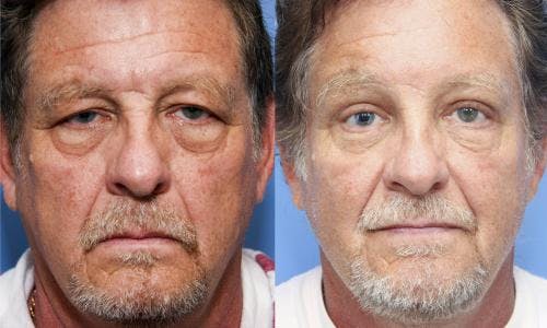 Brow Lift