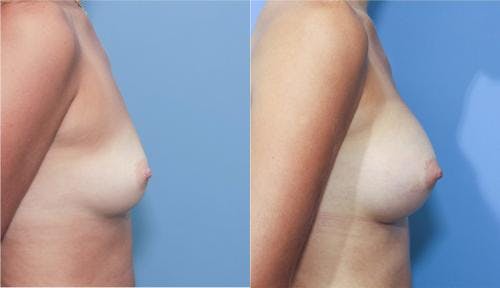 Breast Augmentation Before & After Gallery - Patient 58213185 - Image 3