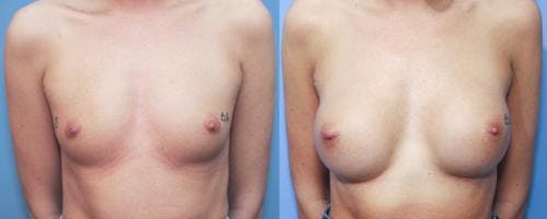 Breast Augmentation Before & After Gallery - Patient 58213187 - Image 1