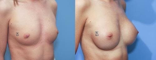 Breast Augmentation Before & After Gallery - Patient 58213187 - Image 2