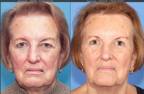 Eyelid Surgery (Upper Blepharoplasty) Before & After Gallery - Patient 58213186 - Image 1