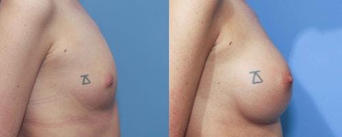 Breast Augmentation Before & After Gallery - Patient 58213187 - Image 3