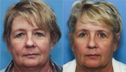 Eyelid Surgery (Upper Blepharoplasty) Before & After Gallery - Patient 58213188 - Image 1