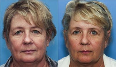 Eyelid Surgery (Upper Blepharoplasty) Before & After Gallery - Patient 58213188 - Image 1