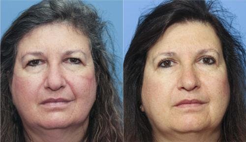 Eyelid Surgery (Blepharoplasty) Before & After Gallery - Patient 58213189 - Image 1