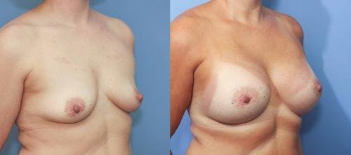 Breast Augmentation Before & After Gallery - Patient 58213190 - Image 3