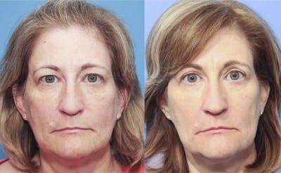 Eyelid Surgery (Upper Blepharoplasty) Before & After Gallery - Patient 58213191 - Image 1