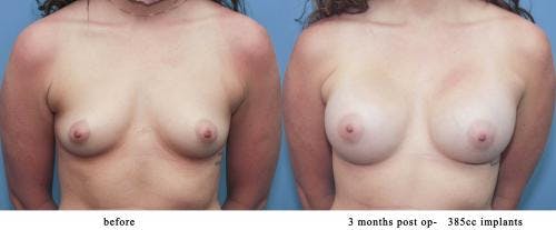 Breast Augmentation Before & After Gallery - Patient 58213192 - Image 1