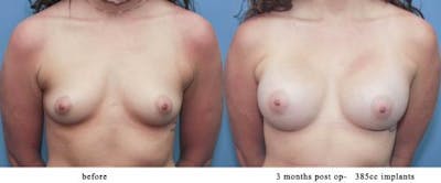 Breast Augmentation Before & After Gallery - Patient 58213192 - Image 1