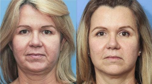 Eyelid Surgery (Blepharoplasty) Before & After Gallery - Patient 58213193 - Image 1