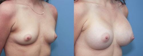 Breast Augmentation Before & After Gallery - Patient 58213192 - Image 3