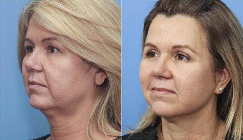 Eyelid Surgery (Upper Blepharoplasty) Before & After Gallery - Patient 58213193 - Image 2