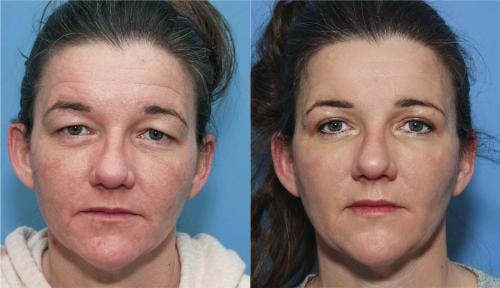 Eyelid Surgery (Blepharoplasty) Before & After Gallery - Patient 58213195 - Image 1
