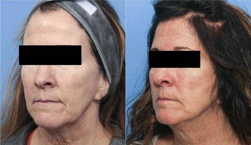 Face Lift Before & After Gallery - Patient 58213197 - Image 2