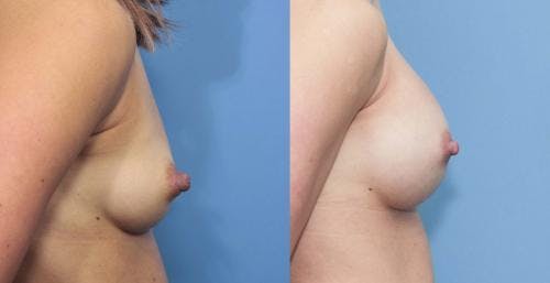 Breast Augmentation Before & After Gallery - Patient 58213196 - Image 2