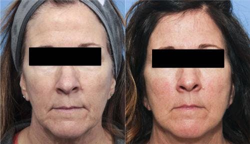 Face Lift Before & After Gallery - Patient 58213197 - Image 1
