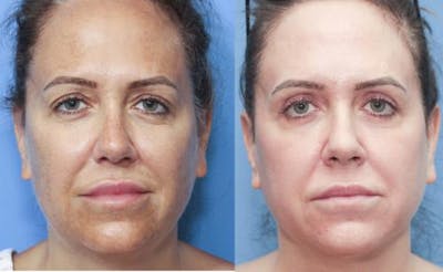 Eyelid Surgery (Upper Blepharoplasty) Before & After Gallery - Patient 58213198 - Image 1