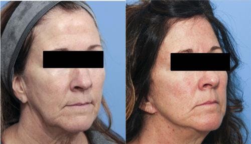 Face Lift Before & After Gallery - Patient 58213197 - Image 3