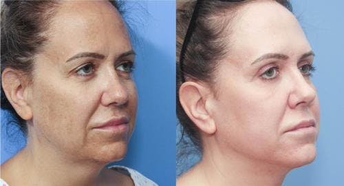 Eyelid Surgery (Blepharoplasty) Before & After Gallery - Patient 58213198 - Image 4