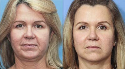 Face Lift Before & After Gallery - Patient 58213200 - Image 1