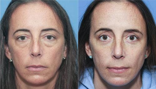 Eyelid Surgery (Upper & Lower Blepharoplasty) Before & After Gallery - Patient 159270 - Image 1