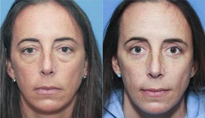 Eyelid Surgery (Upper & Lower Blepharoplasty) Before & After Gallery - Patient 159270 - Image 1