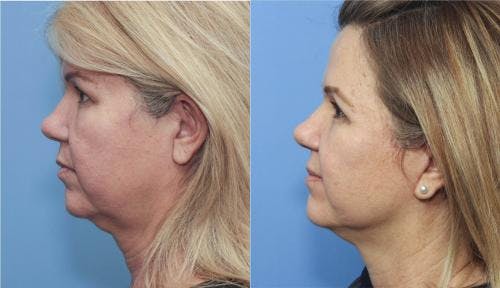 Face Lift Before & After Gallery - Patient 58213200 - Image 3