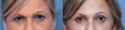 Eyelid Surgery (Blepharoplasty) Before & After Gallery - Patient 58213202 - Image 1