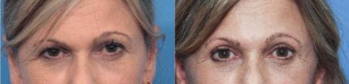 Eyelid Surgery (Upper Blepharoplasty) Before & After Gallery - Patient 58213202 - Image 1